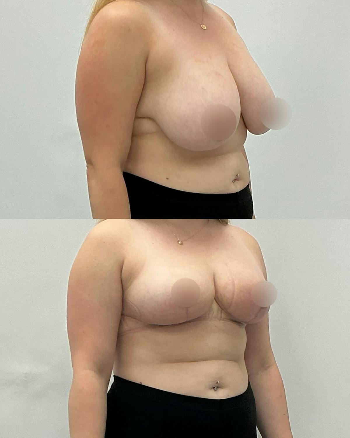 Breast Reduction Before & After Gallery - Patient 124505 - Image 2
