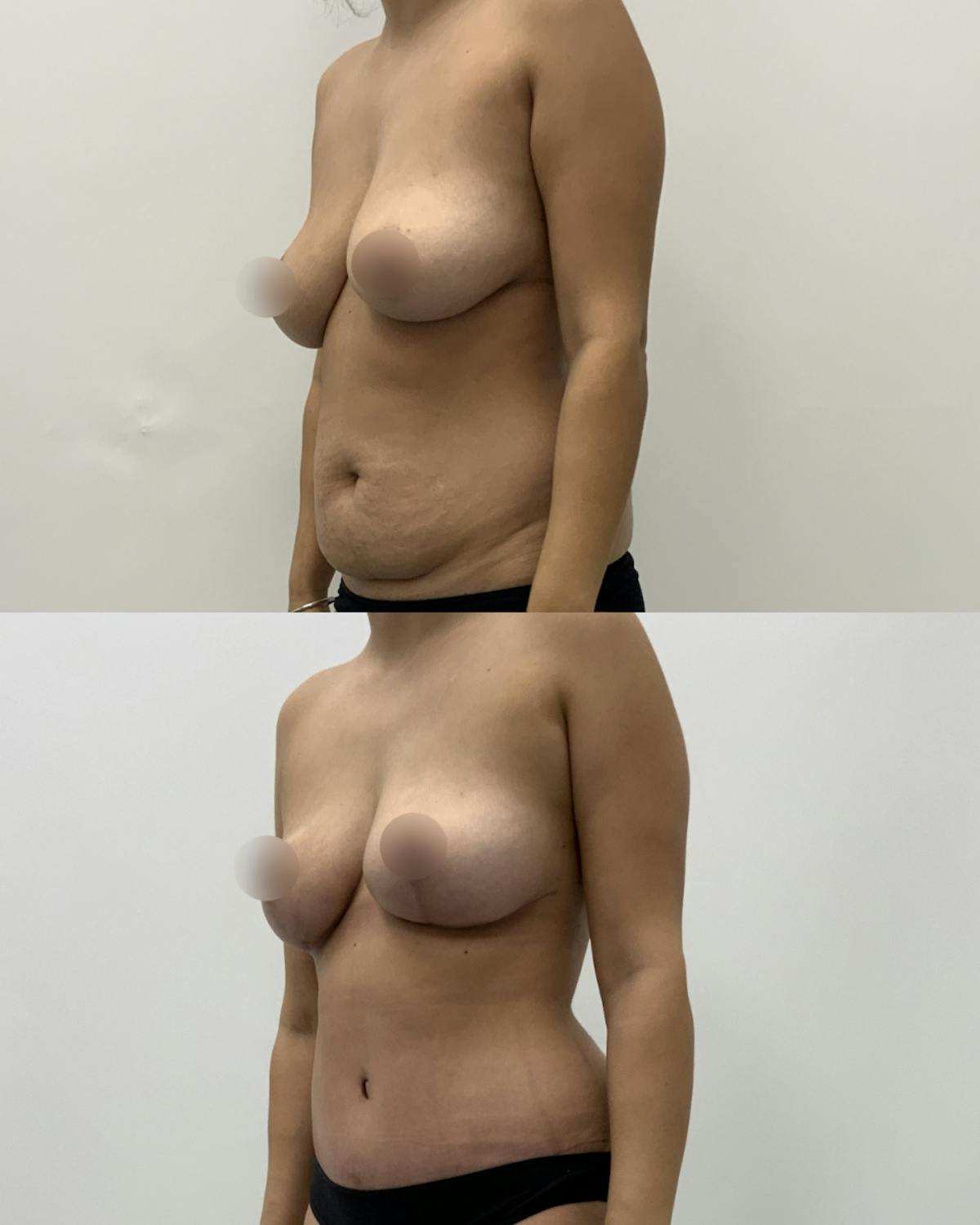 Mommy Makeover Before & After Gallery - Patient 403958 - Image 2