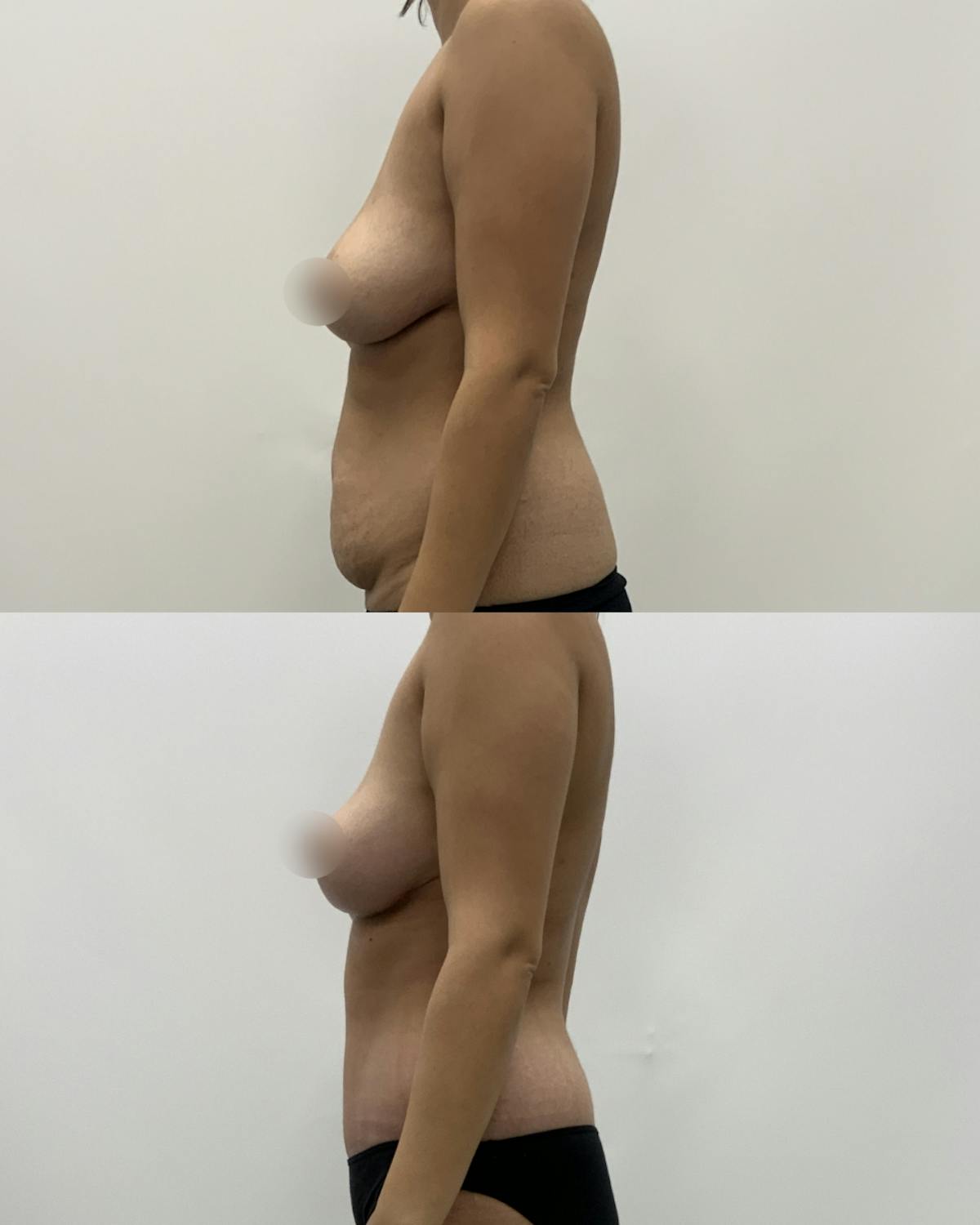 Mommy Makeover Before & After Gallery - Patient 403958 - Image 3