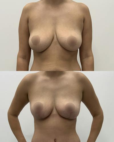 Breast Lift Before & After Gallery - Patient 236759 - Image 1