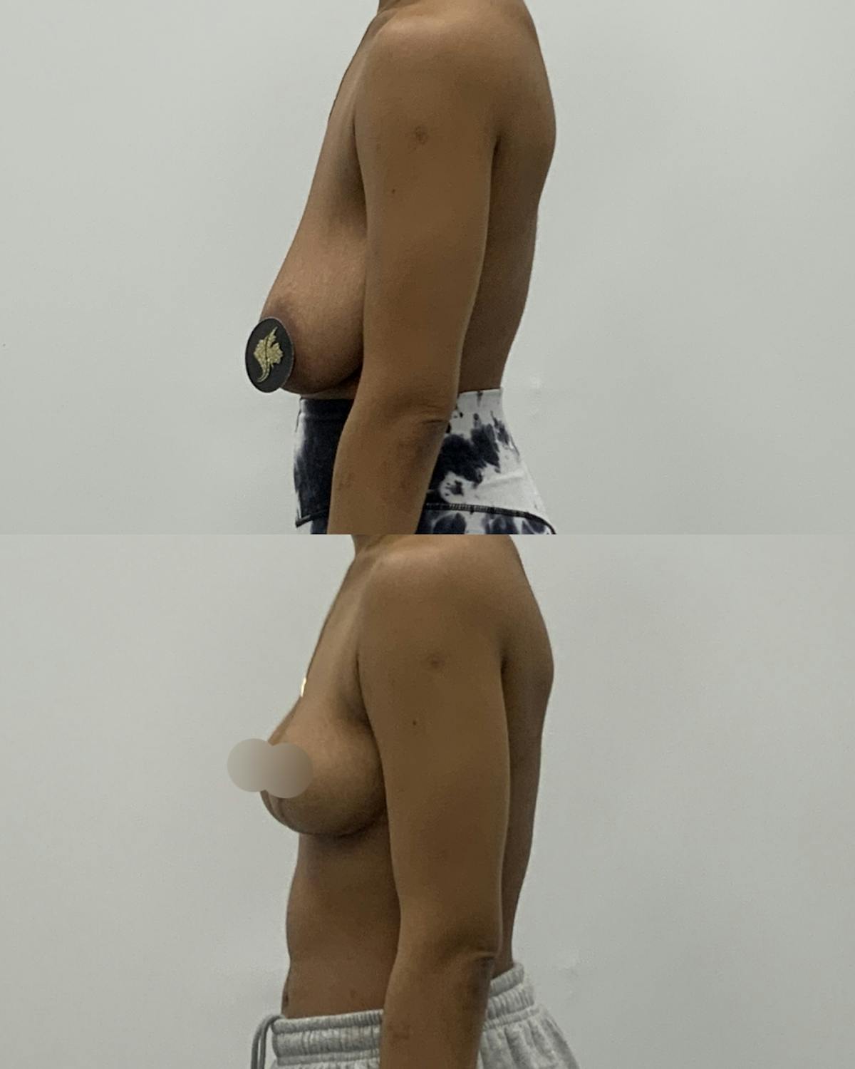 Breast Reduction Before & After Gallery - Patient 358773 - Image 3