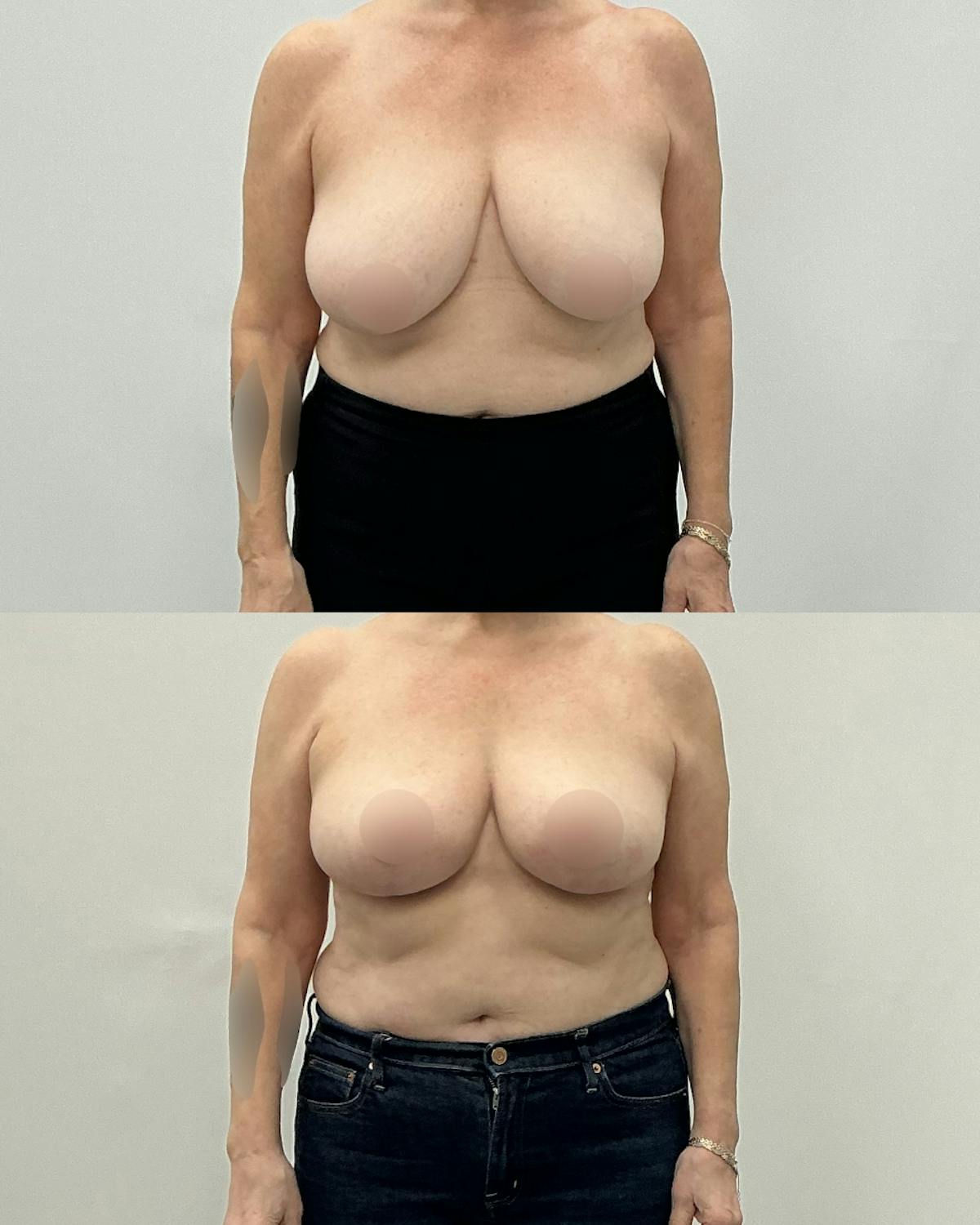 Breast Reduction Before & After Gallery - Patient 181282 - Image 1