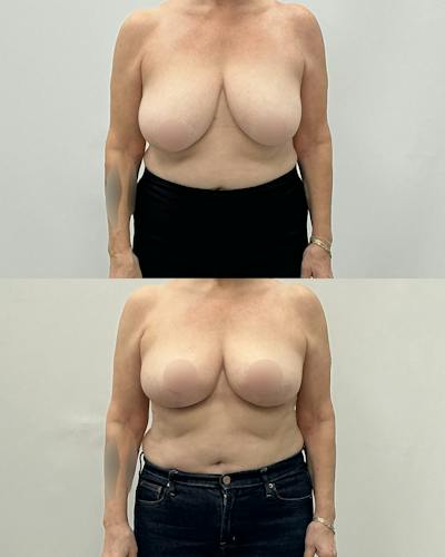 Breast Lift Before & After Gallery - Patient 384287 - Image 1