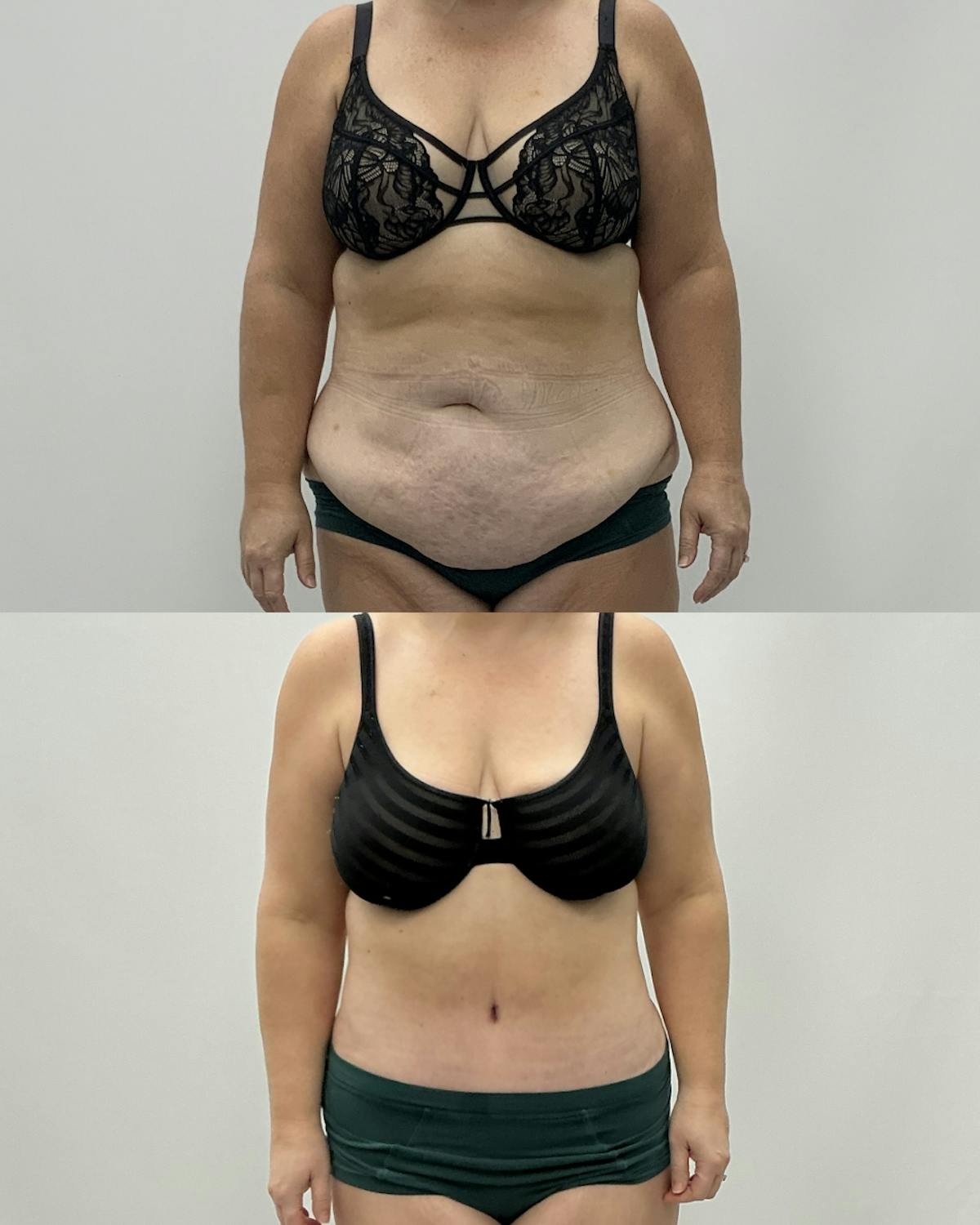 Tummy Tuck Before & After Gallery - Patient 122462 - Image 1