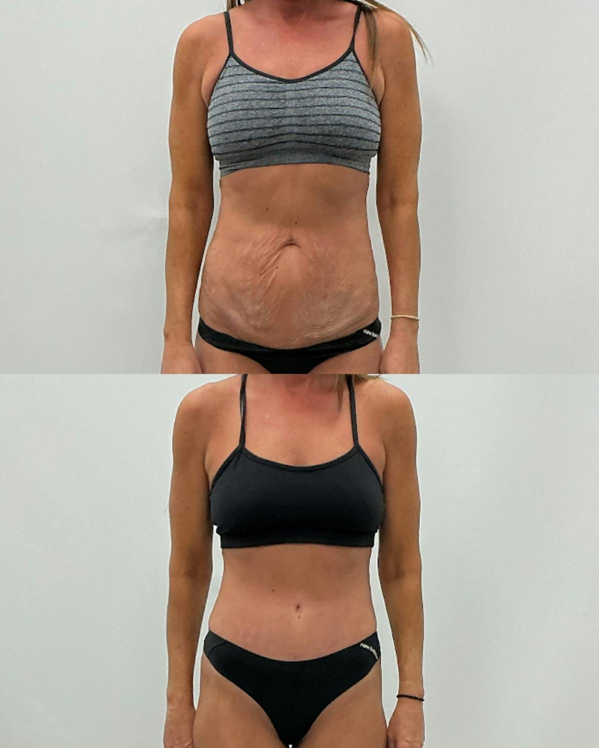 Tummy Tuck Before & After Gallery - Patient 210836 - Image 1