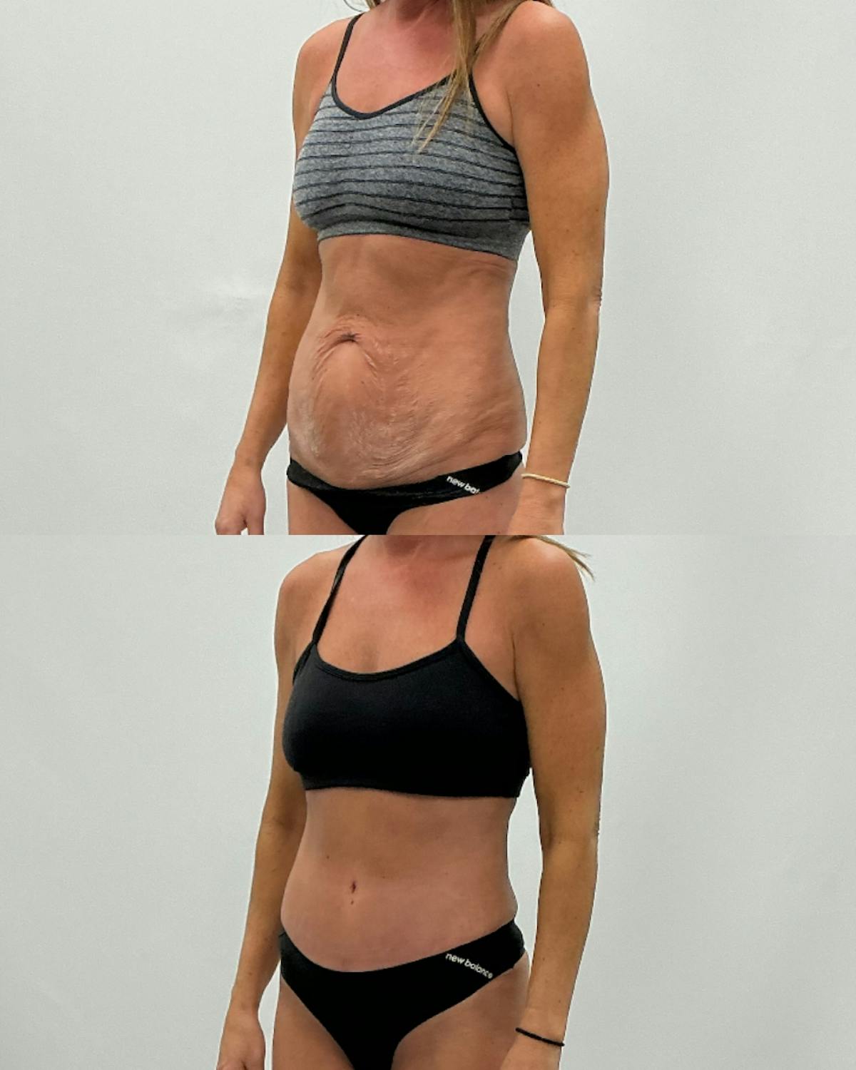 Tummy Tuck Before & After Gallery - Patient 210836 - Image 2