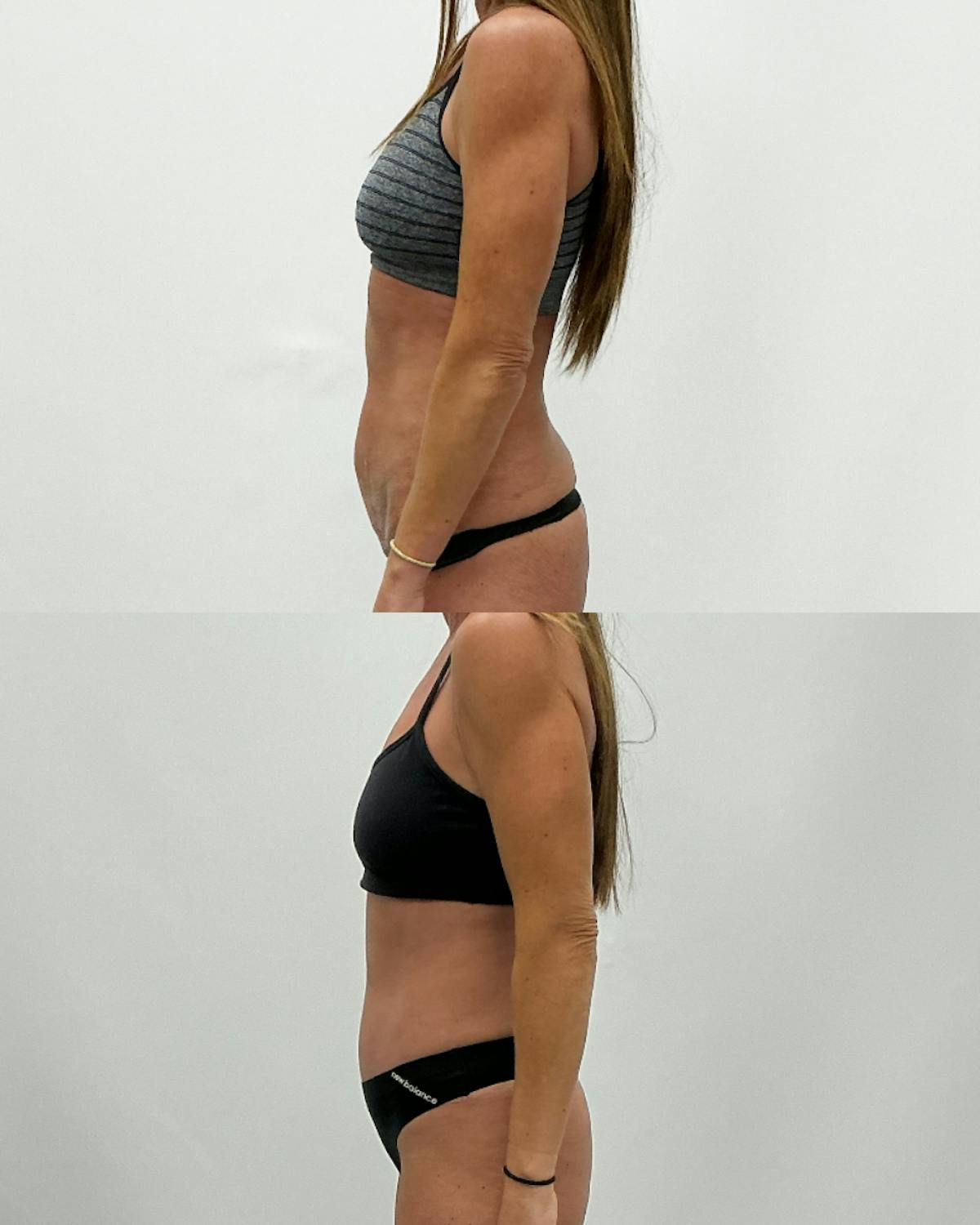 Tummy Tuck Before & After Gallery - Patient 210836 - Image 3