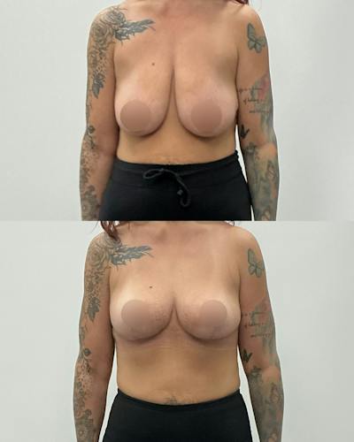 Breast Lift Before & After Gallery - Patient 393267 - Image 1