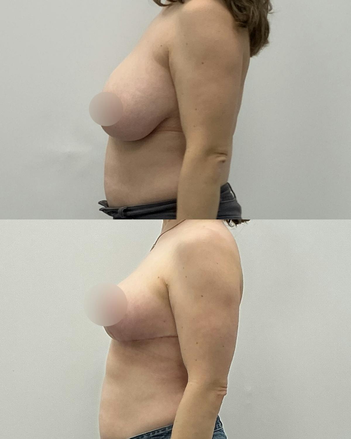 Breast Reduction Before & After Gallery - Patient 273804 - Image 3