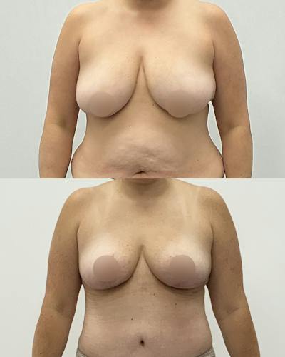 Breast Lift Before & After Gallery - Patient 115477 - Image 1