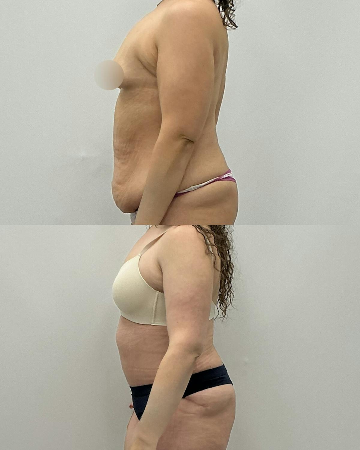 Tummy Tuck Before & After Gallery - Patient 109214 - Image 3