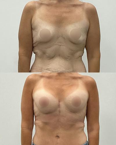 Breast Augmentation Before & After Gallery - Patient 193305 - Image 1