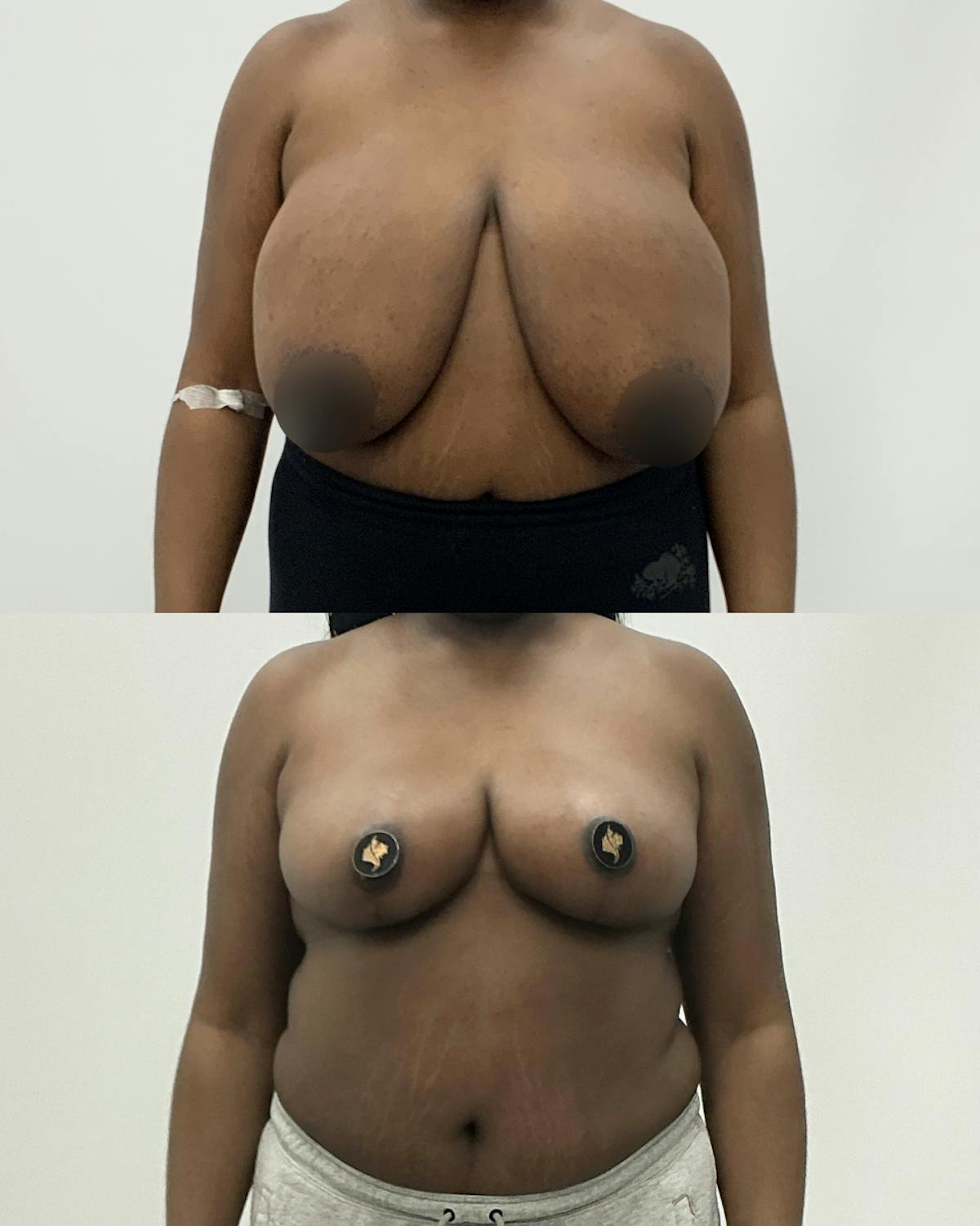 Breast Reduction Before & After Gallery - Patient 259061 - Image 1