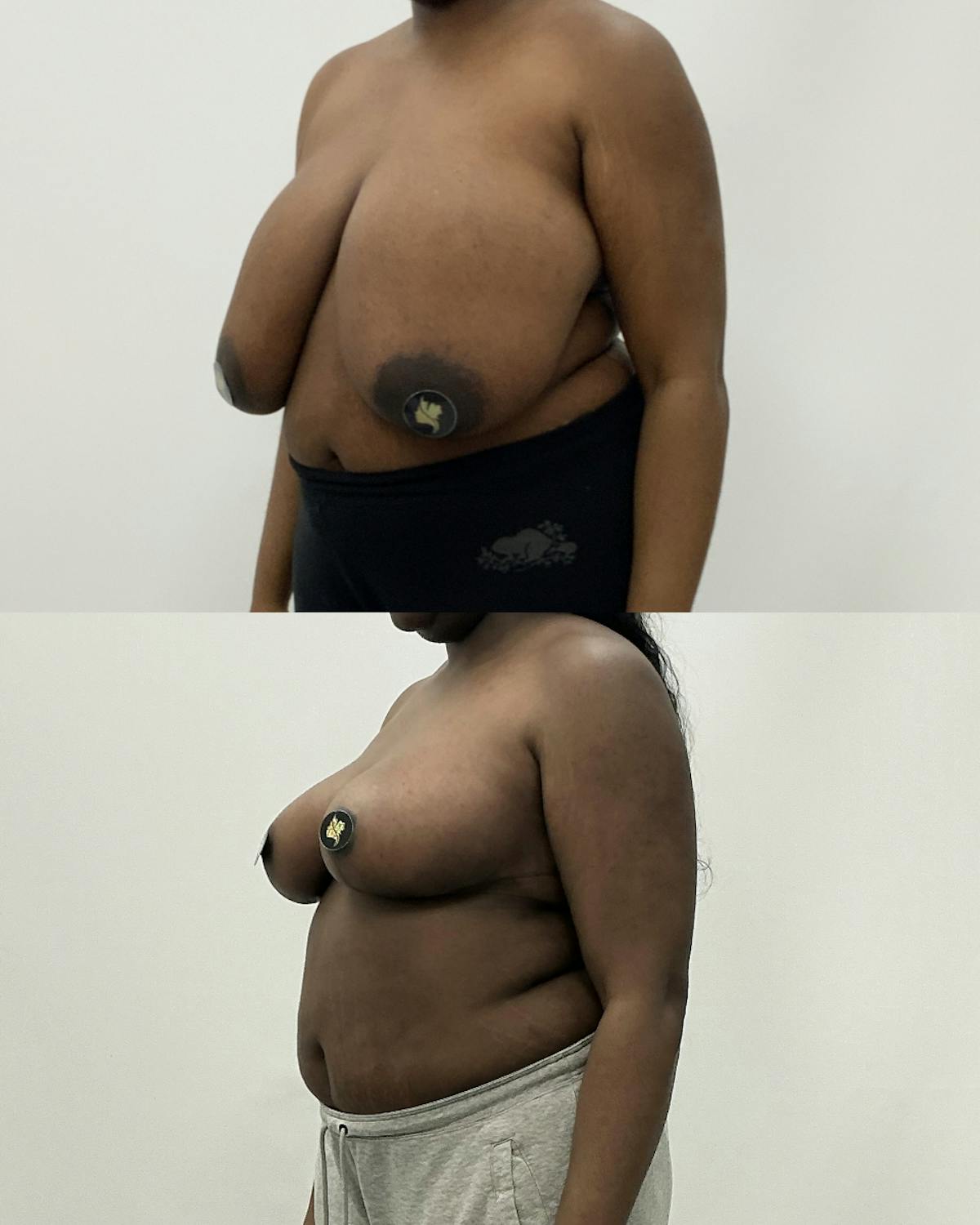 Breast Reduction Before & After Gallery - Patient 259061 - Image 2