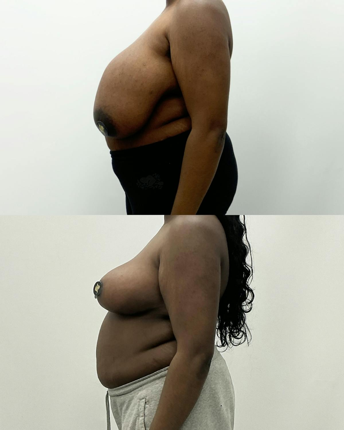 Breast Reduction Before & After Gallery - Patient 259061 - Image 3
