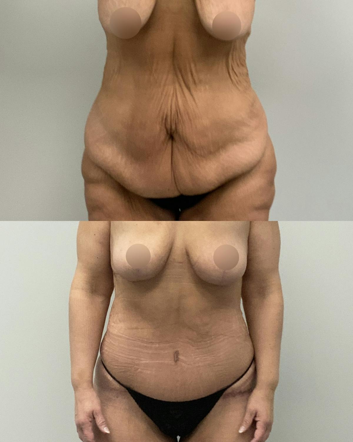 Tummy Tuck Before & After Gallery - Patient 119641 - Image 1