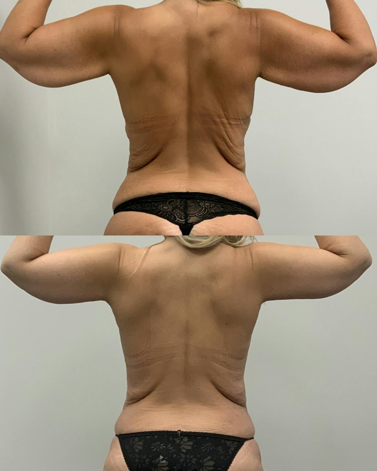 Arm Lift Before & After Gallery - Patient 261217 - Image 1