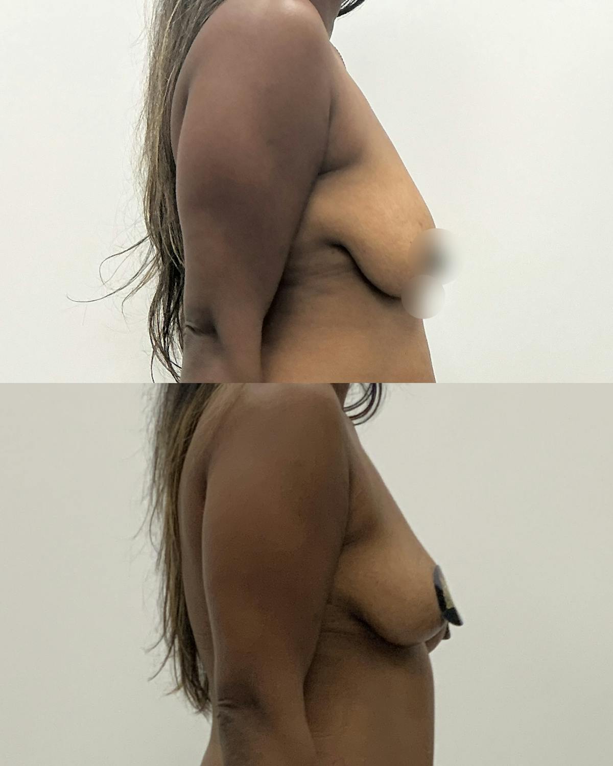 Breast Reduction Before & After Gallery - Patient 145442 - Image 3