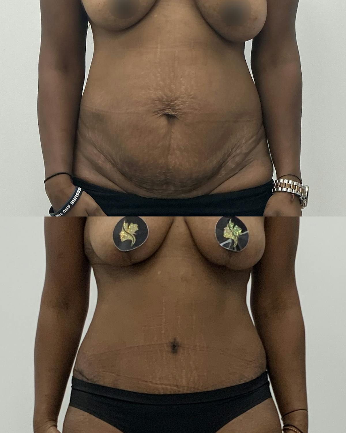 Tummy Tuck Before & After Gallery - Patient 120728 - Image 1
