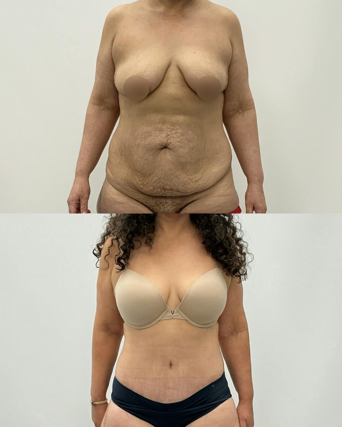 Tummy Tuck Before & After Gallery - Patient 291567 - Image 1