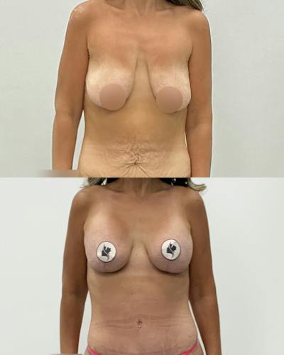 Breast Lift Before & After Gallery - Patient 358724 - Image 1