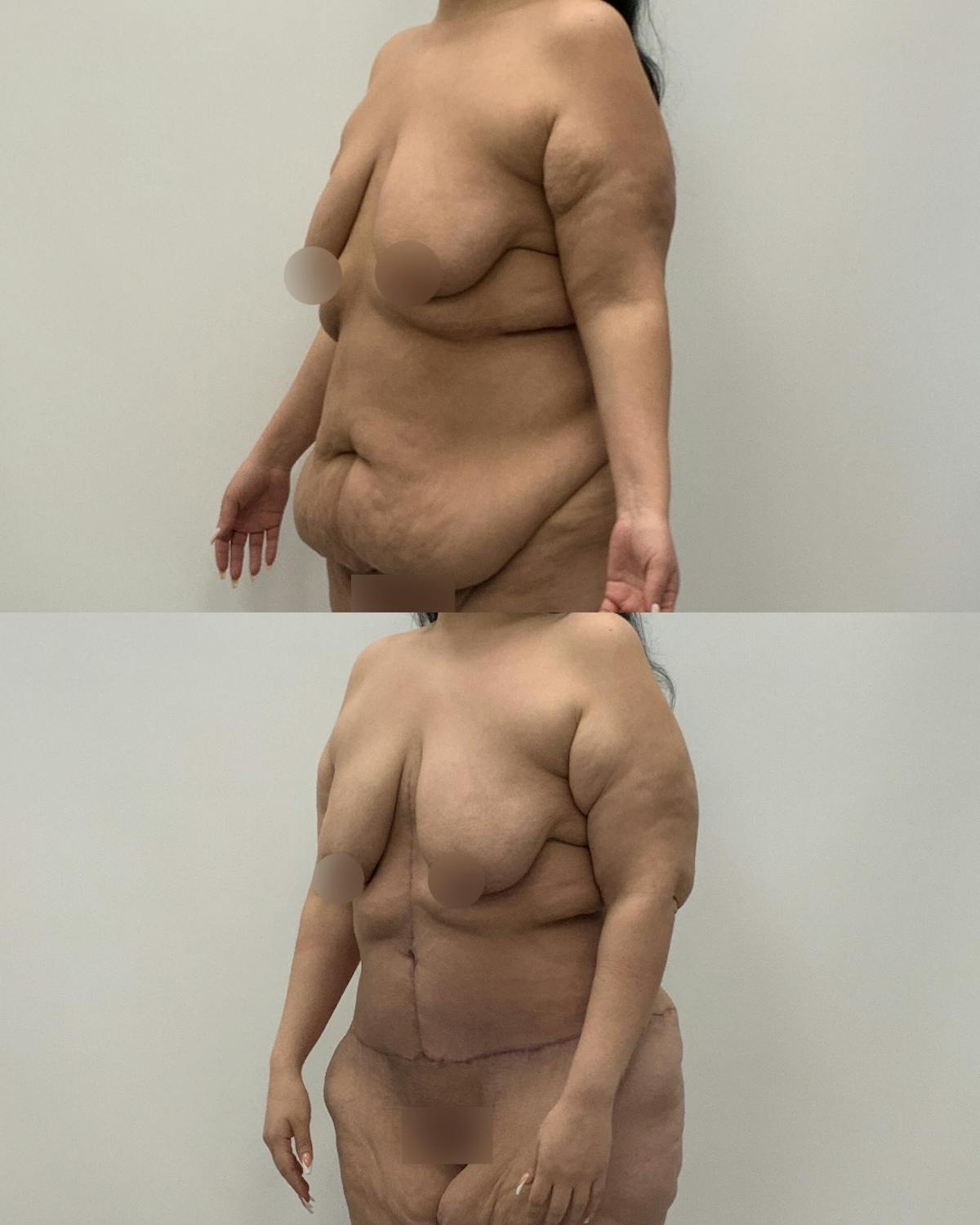 Post-Bariatric Body Contouring Before & After Gallery - Patient 199165 - Image 2
