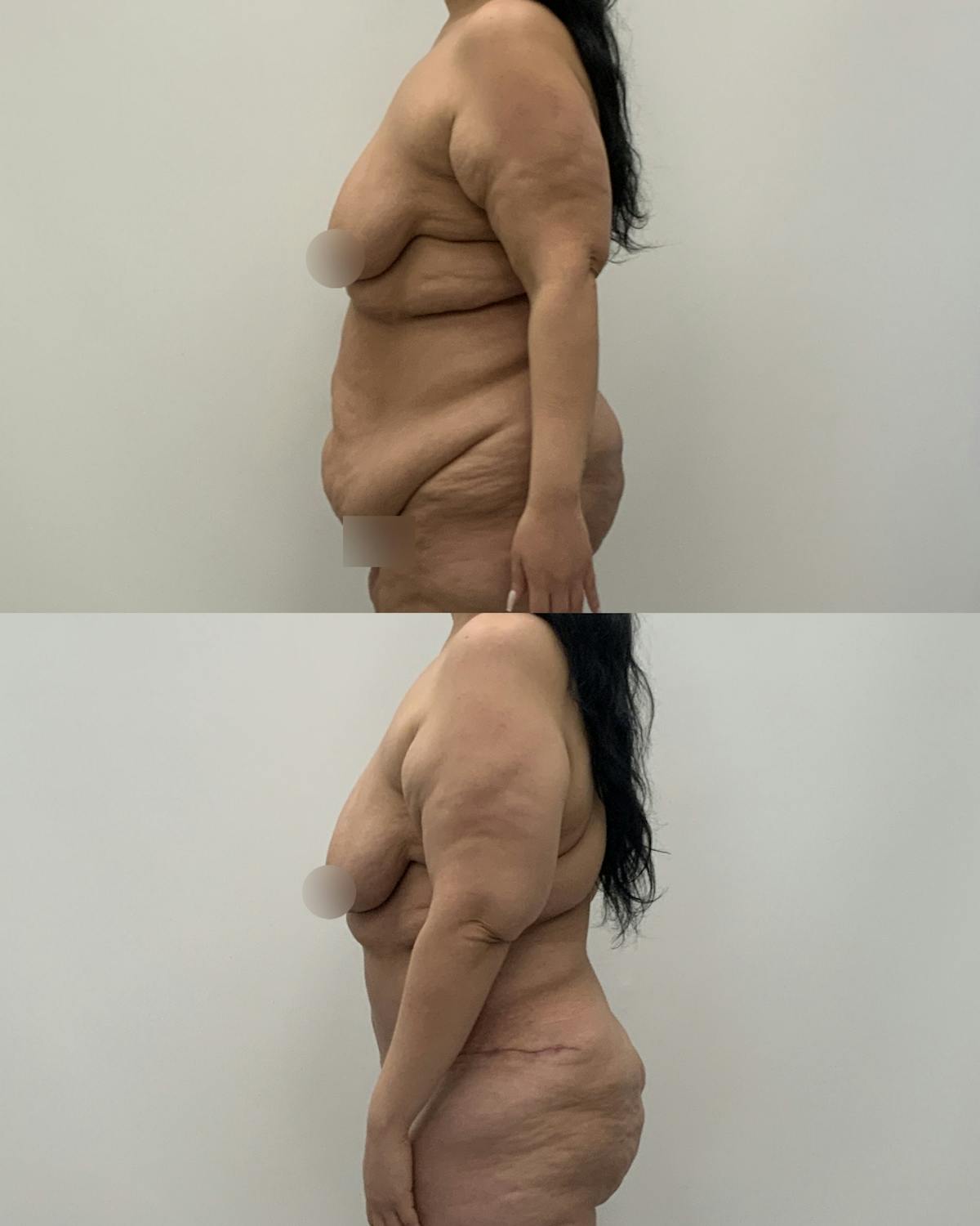 Post-Bariatric Body Contouring Before & After Gallery - Patient 199165 - Image 3