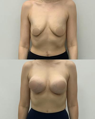 Breast Augmentation Before & After Gallery - Patient 181063 - Image 1