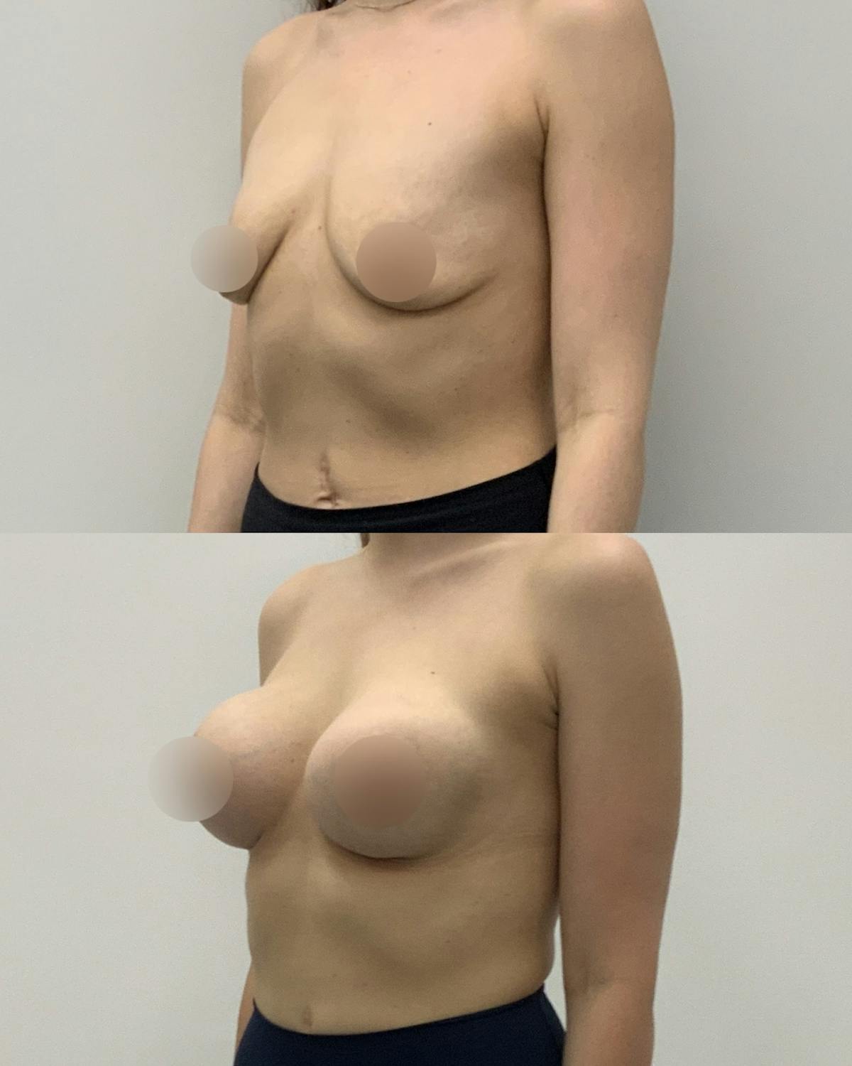 Breast Augmentation Before & After Gallery - Patient 181063 - Image 2