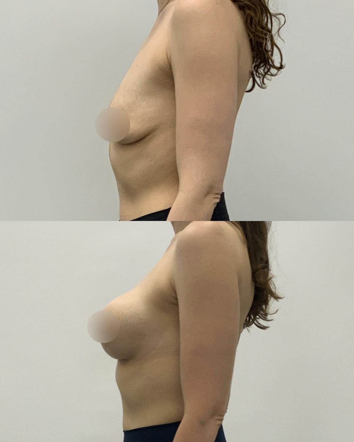 Breast Augmentation Before & After Gallery - Patient 181063 - Image 3