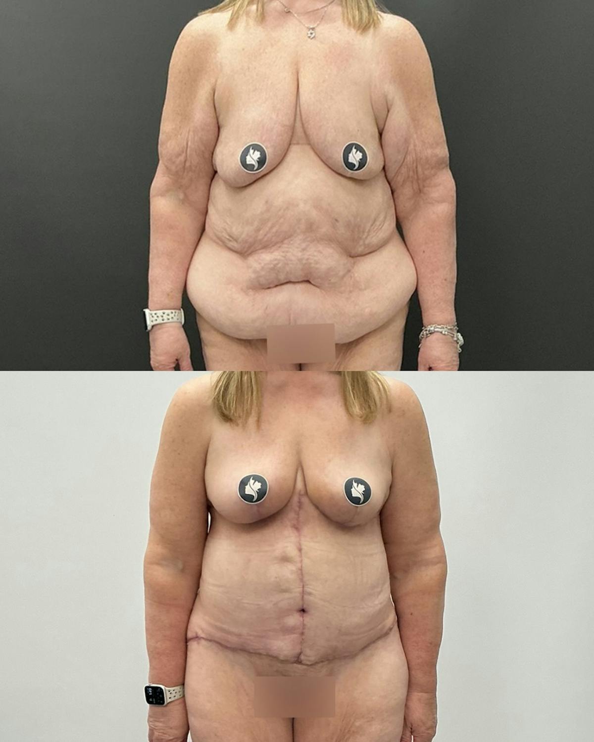 Post-Bariatric Body Contouring Before & After Gallery - Patient 628321 - Image 1