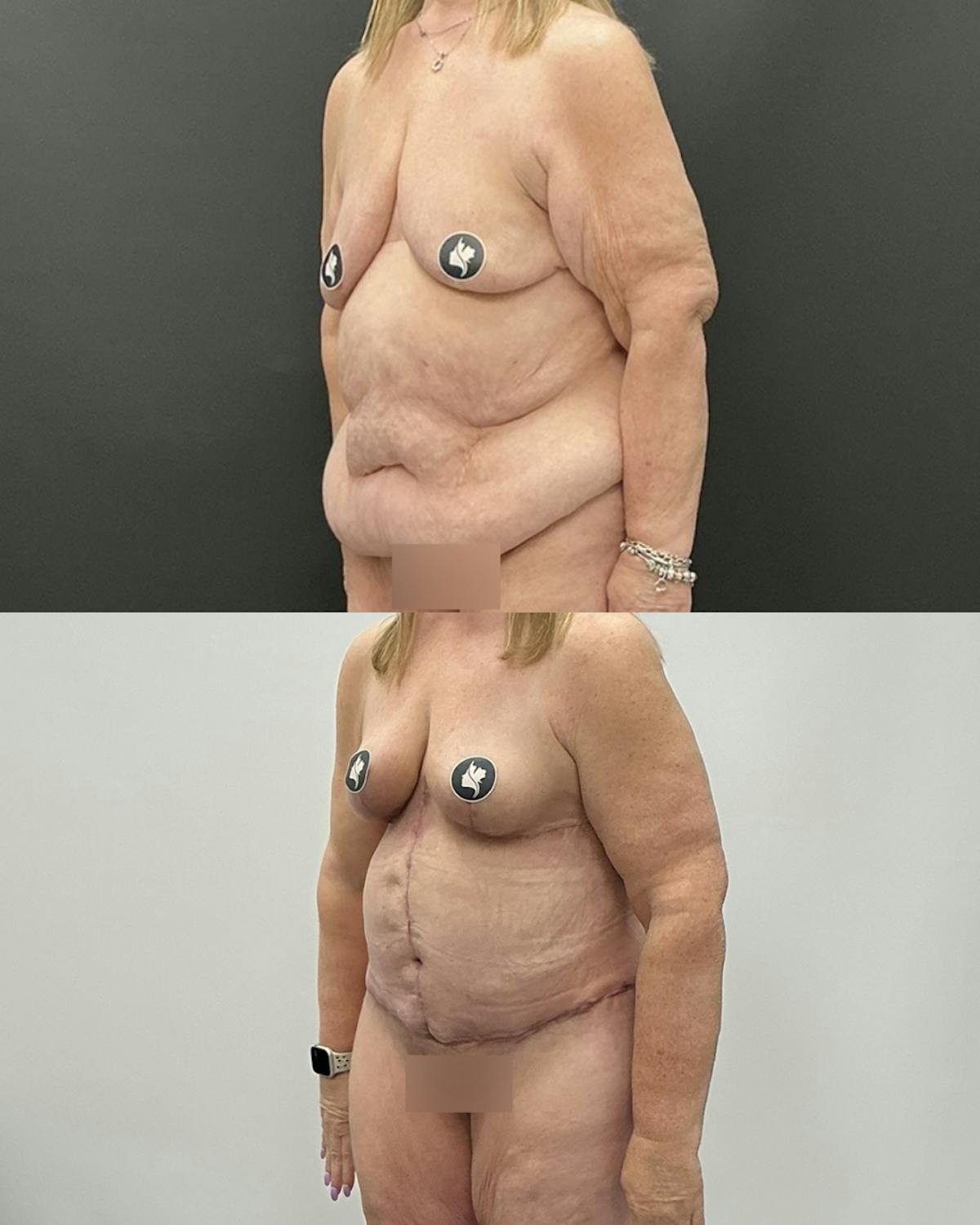 Post-Bariatric Body Contouring Before & After Gallery - Patient 628321 - Image 2