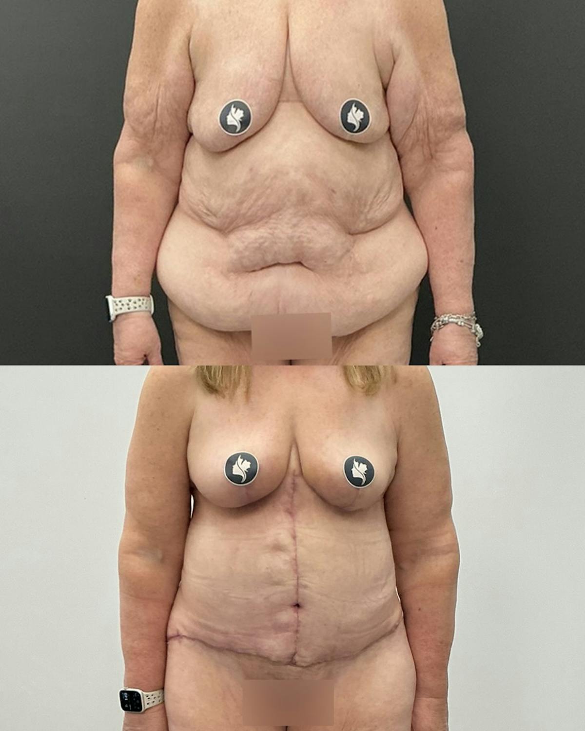 Tummy Tuck Before & After Gallery - Patient 114455 - Image 1