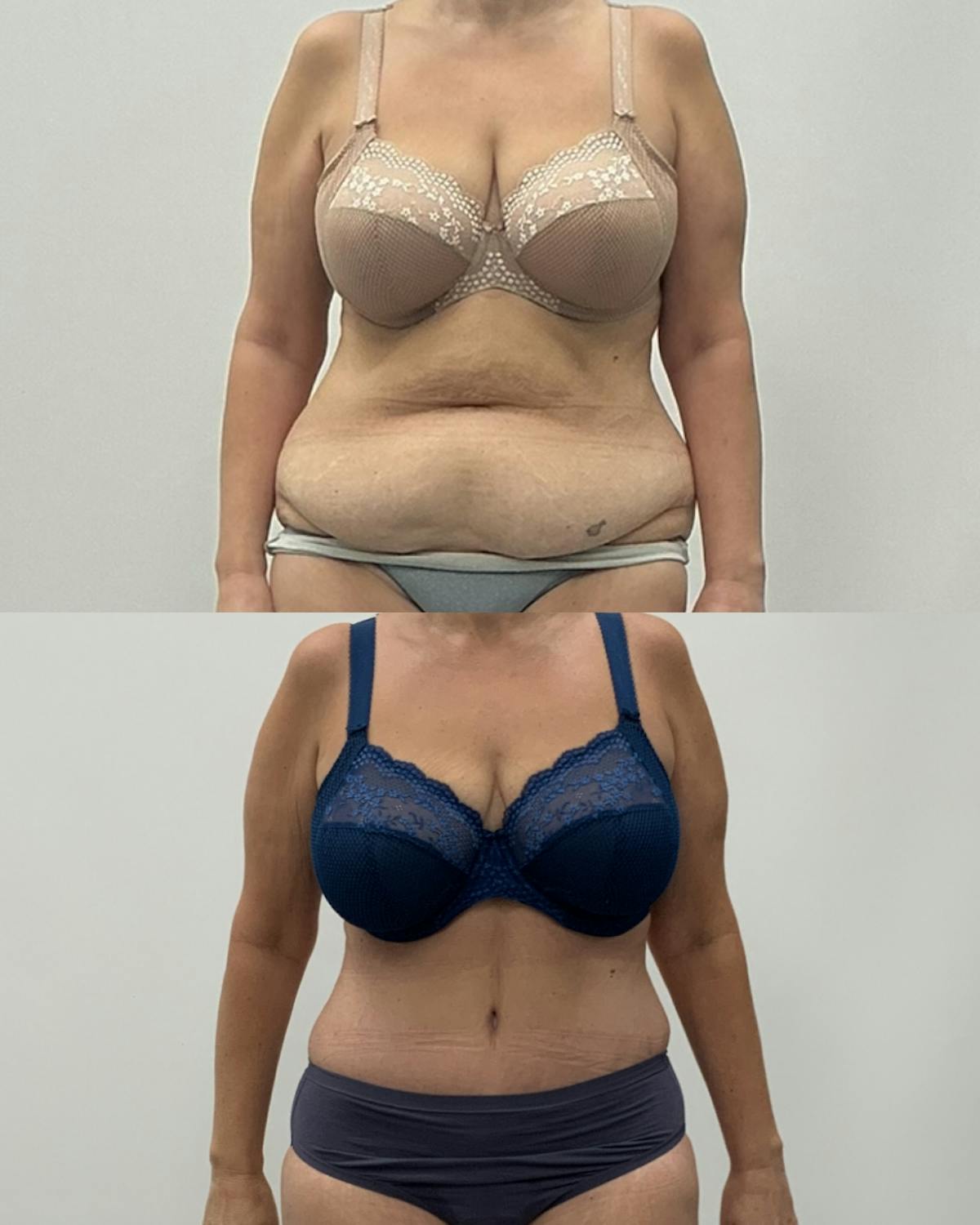 Tummy Tuck Before & After Gallery - Patient 207560 - Image 1