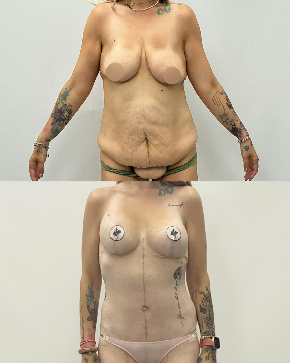 Mommy Makeover Before & After Gallery - Patient 140151 - Image 1