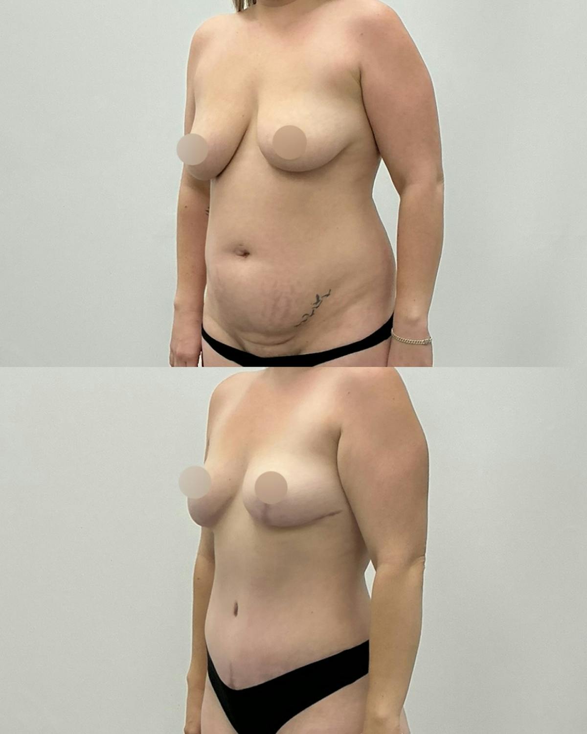 Mommy Makeover Before & After Gallery - Patient 368204 - Image 2