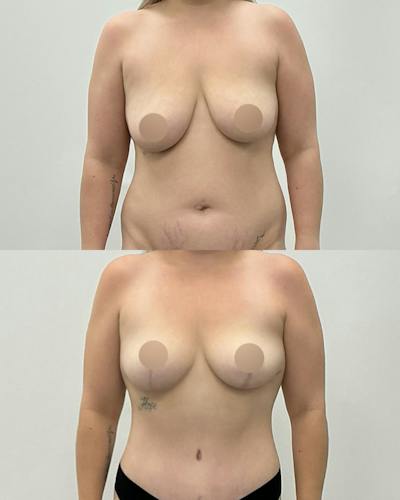 Breast Lift Before & After Gallery - Patient 158216 - Image 1