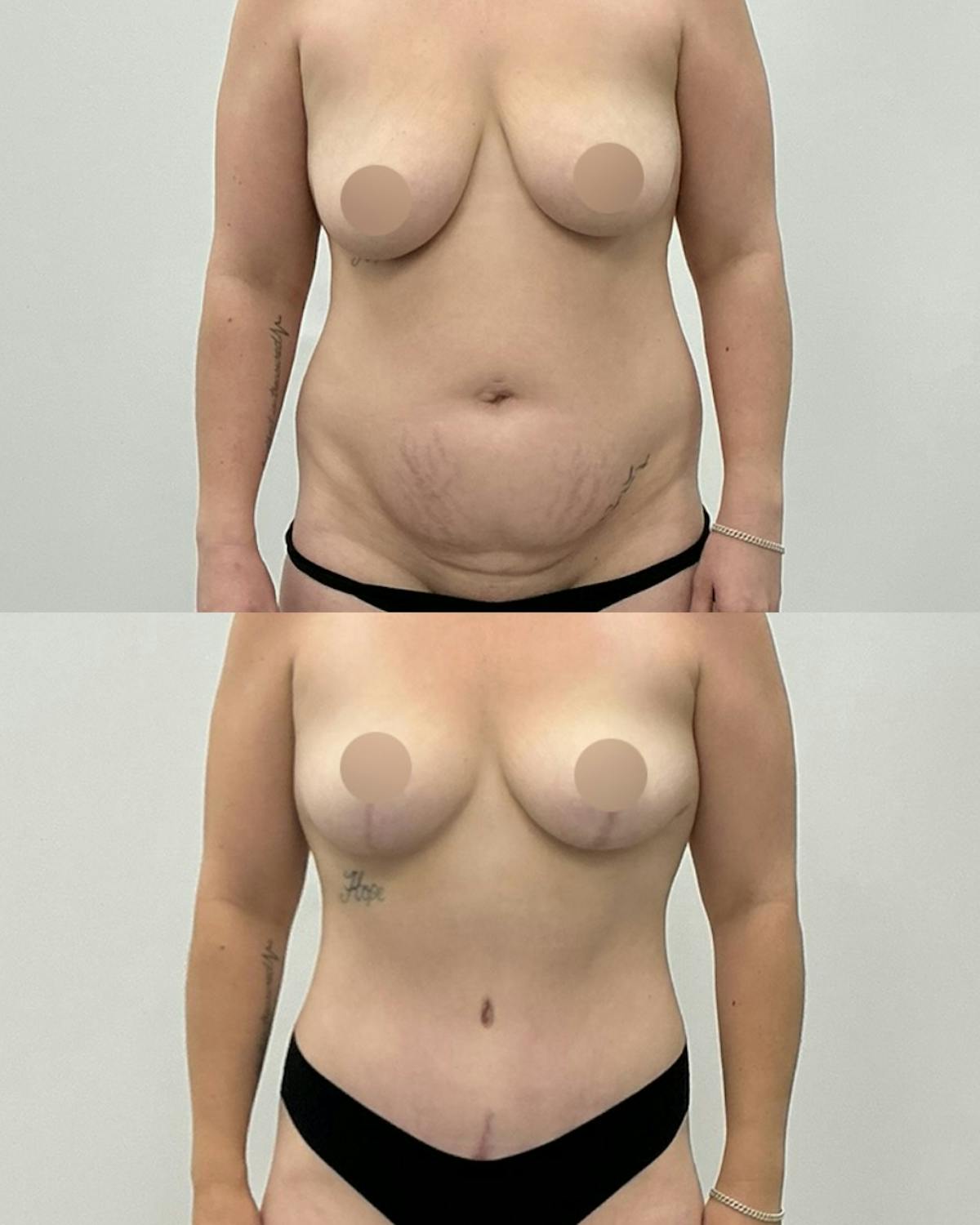 Tummy Tuck Before & After Gallery - Patient 377640 - Image 1