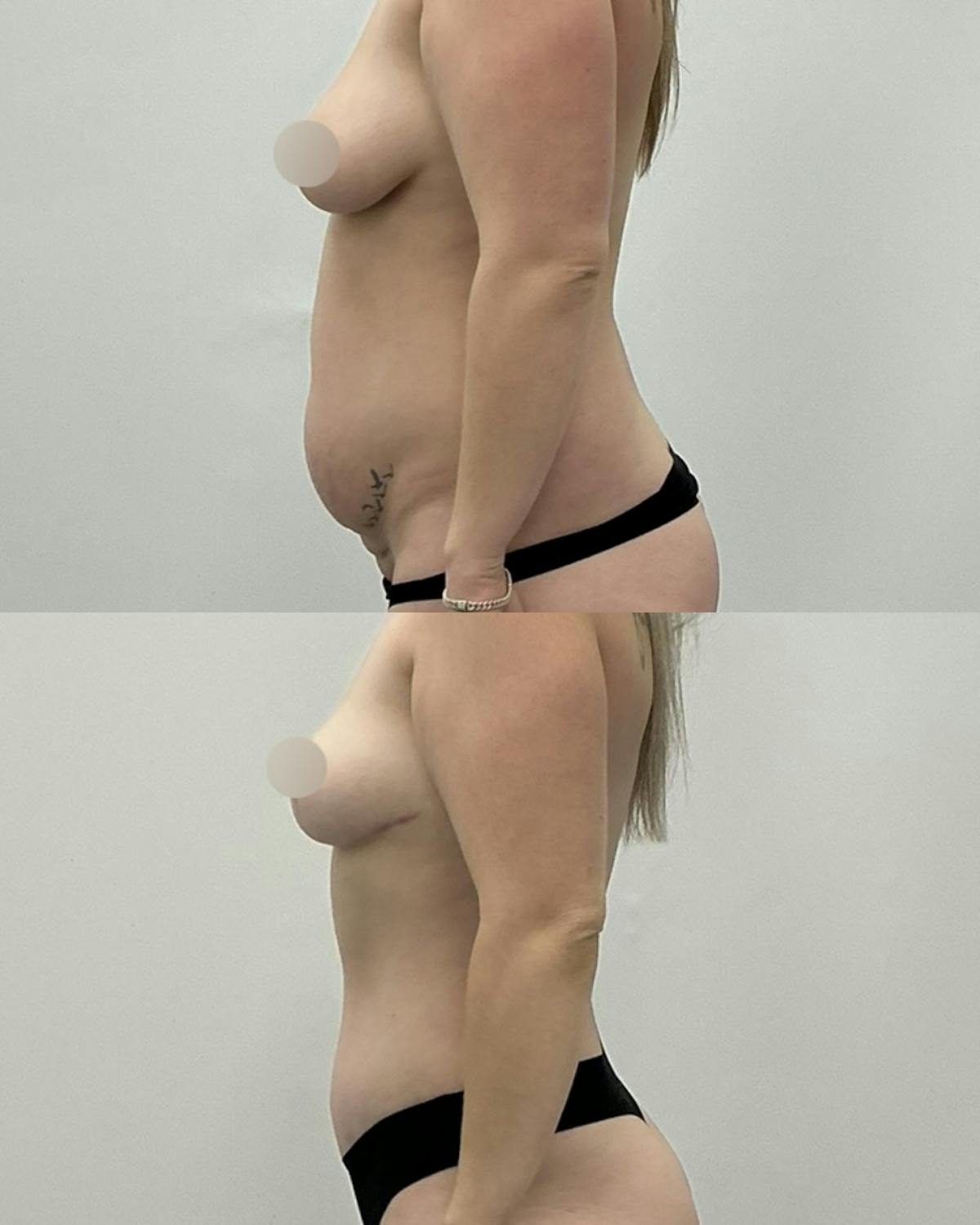 Tummy Tuck Before & After Gallery - Patient 377640 - Image 3