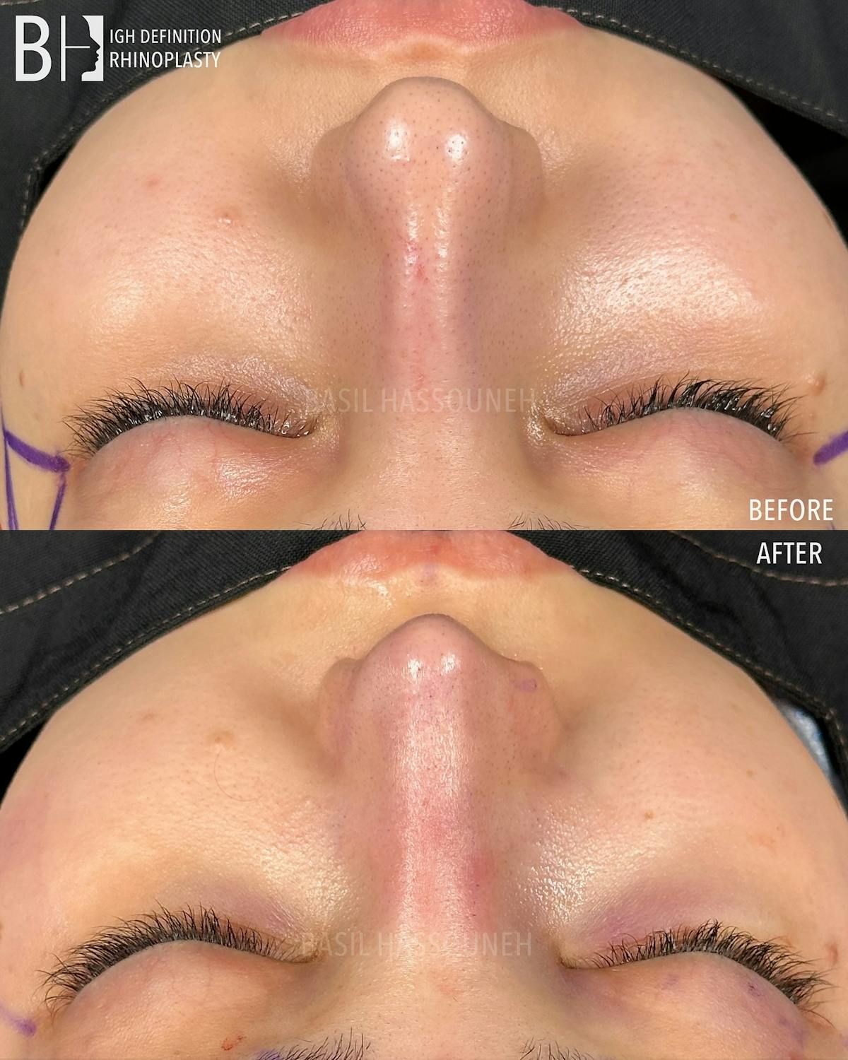 Rhinoplasty Before & After Gallery - Patient 375792 - Image 2