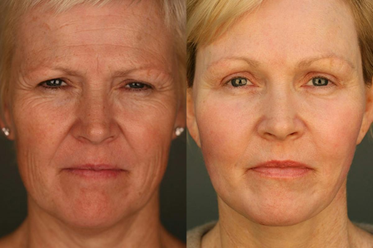 Facelift Before & After Gallery - Patient 428808 - Image 1