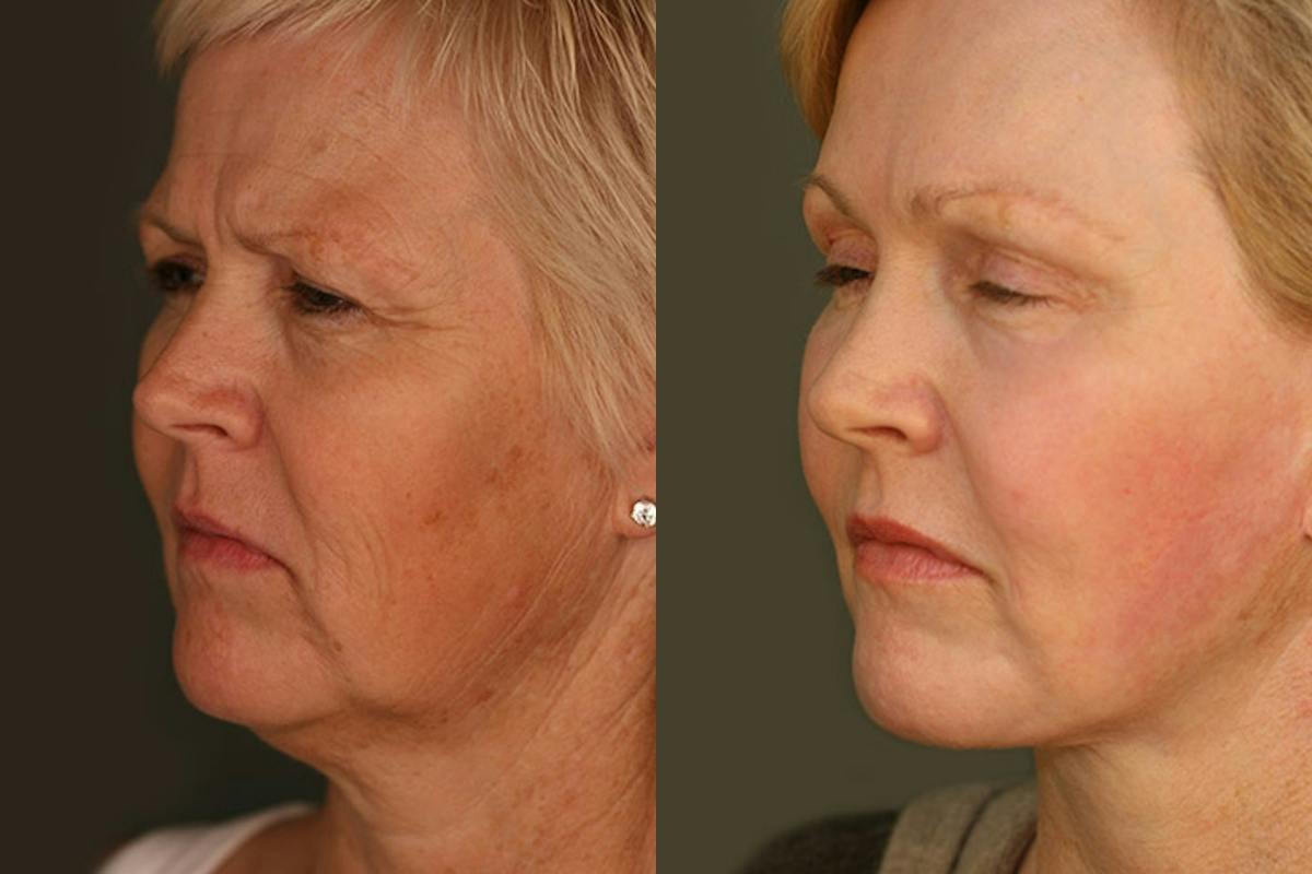 Facelift Before & After Gallery - Patient 428808 - Image 2