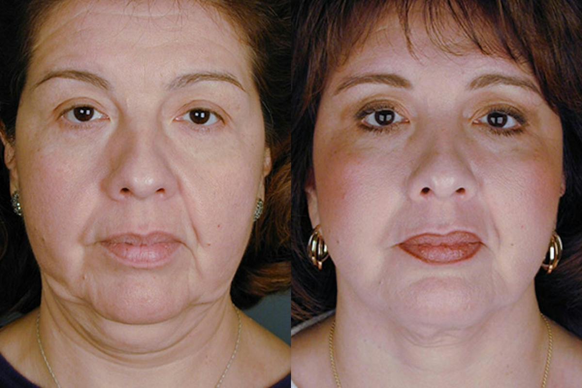 Facelift Before & After Gallery - Patient 322995 - Image 1