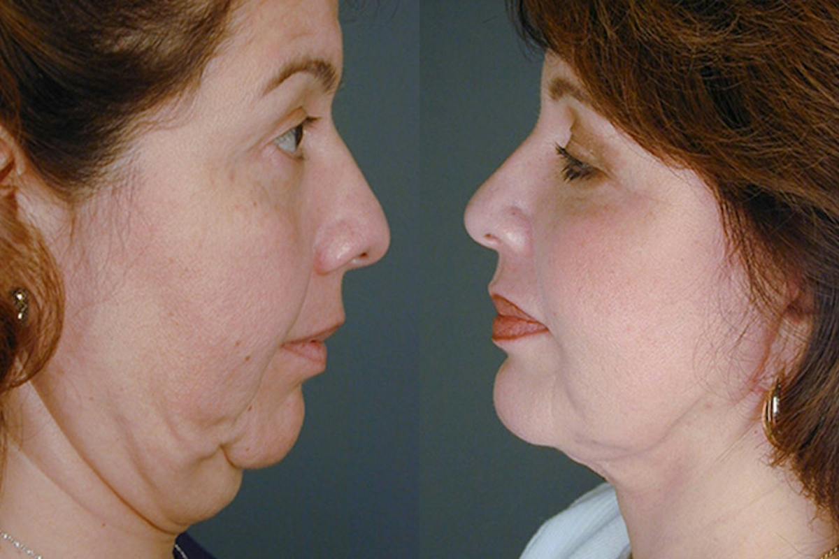 Facelift Before & After Gallery - Patient 322995 - Image 3