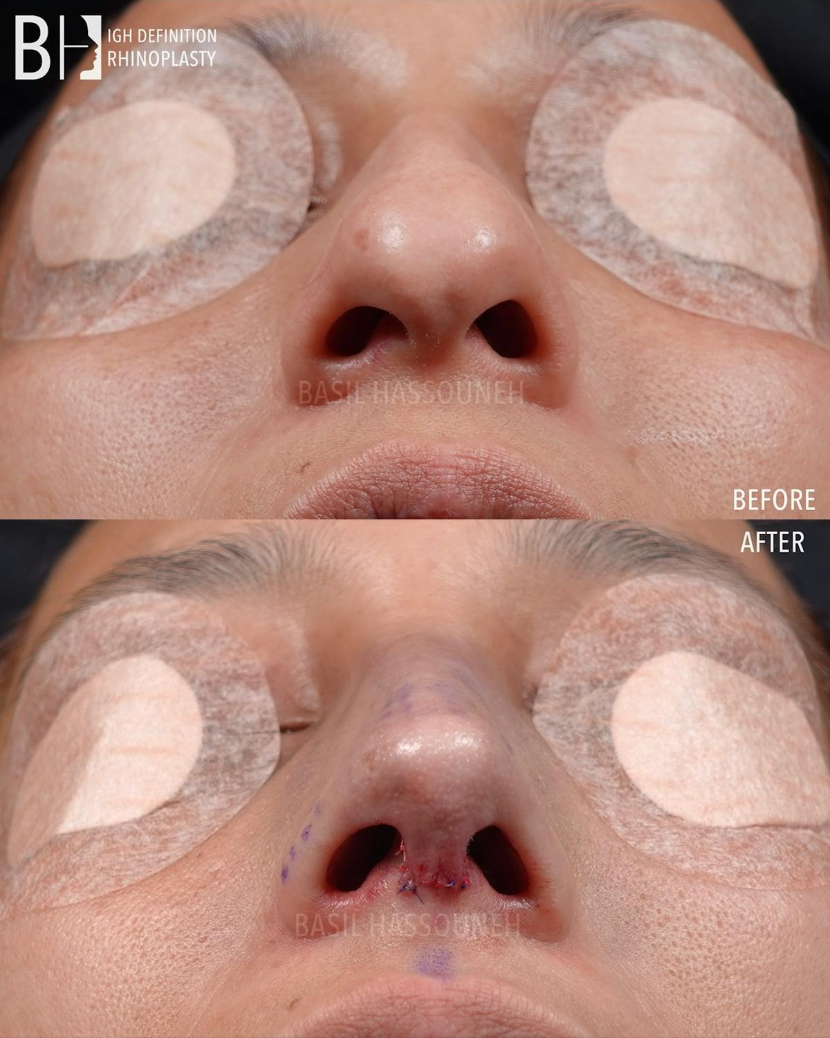 Rhinoplasty Before & After Gallery - Patient 301318 - Image 1