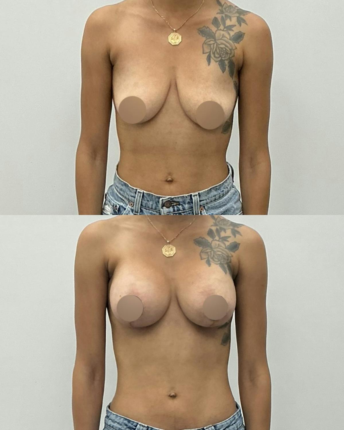 Breast Augmentation Before & After Gallery - Patient 379661 - Image 1