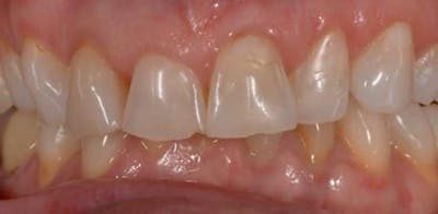 Smile Before & After Gallery - Patient 43748168 - Image 1