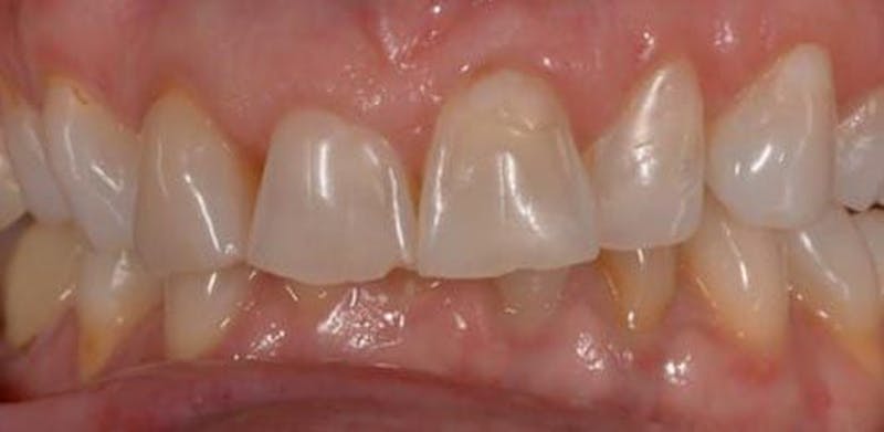 Smile Before & After Gallery - Patient 43748168 - Image 1