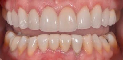 Smile Before & After Gallery - Patient 43748168 - Image 2
