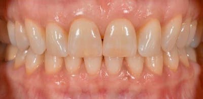 Smile Before & After Gallery - Patient 43748170 - Image 1